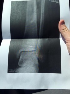 stressfractuur-kuitbeen